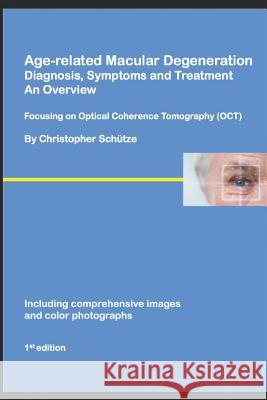 Age-related Macular Degeneration, Diagnosis, Symptoms and Treatment, An Overview: Focusing on Optical Coherence Tomography Schütze, Christopher 9781731404787