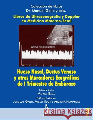 Hueso Nasal, Ductus Venoso Y Otros Marcadores Ecográficos de I Trimestre de Embarazo Gallo, Manuel 9781731531339