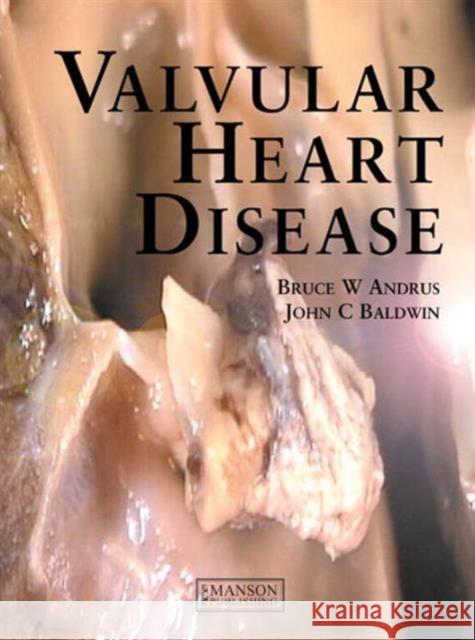 Valvular Heart Disease Bruce Andrus John Baldwin 9781840761368 Thieme/Manson