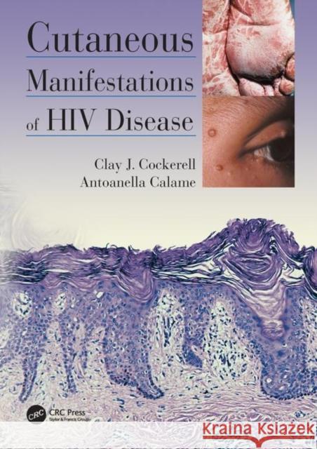 Cutaneous Manifestations of HIV Disease Clay Cockerell 9781840761429 0