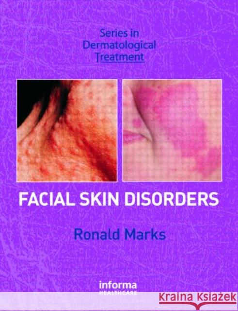 Facial Skin Disorders Ronald Marks 9781841842103