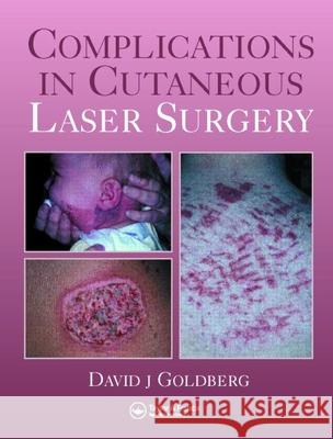 Complications in Laser Cutaneous Surgery David Goldberg                           David J. Goldberg 9781841842455 Taylor & Francis Group