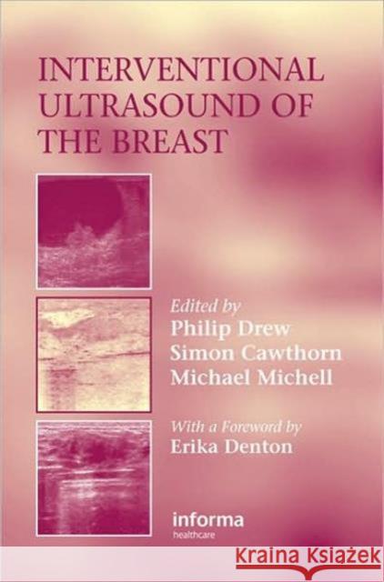 Interventional Ultrasound of the Breast Simon Cawthorne Mike Michell Philip Drew 9781841844169 Informa Healthcare
