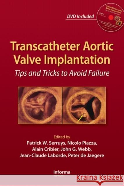 Transcatheter Aortic Valve Implantation: Tips and Tricks to Avoid Failure [With DVD] Serruys, Patrick W. 9781841846897 Informa Healthcare