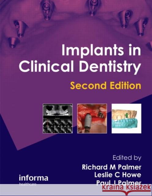 Implants in Clinical Dentistry PALMER, R 9781841849065 