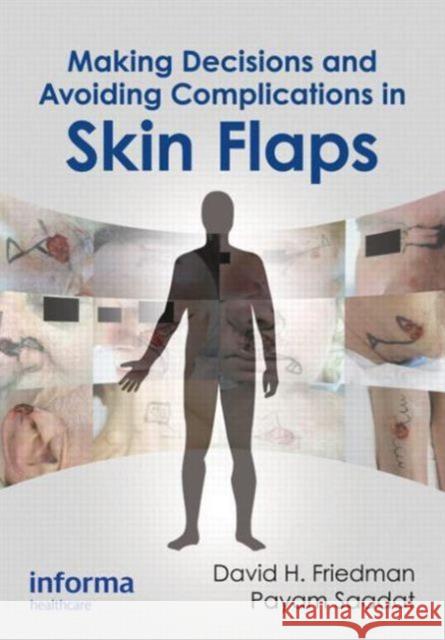 Making Decisions and Avoiding Complications in Skin Flaps David Friedman Payam Saadat  9781841849850 Informa Healthcare