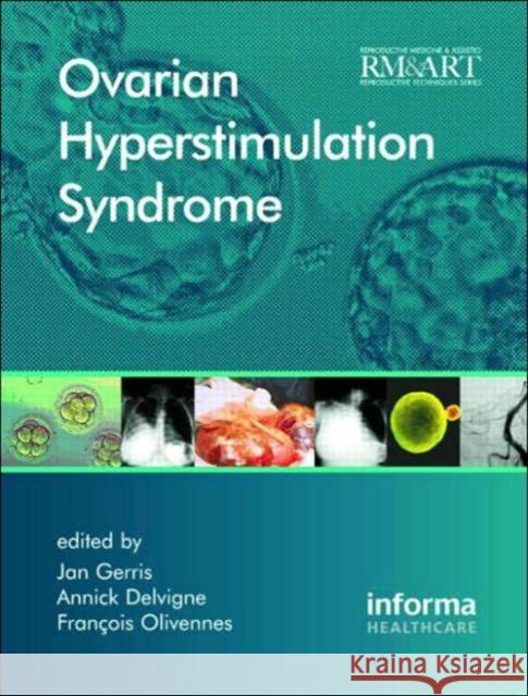 Ovarian Hyperstimulation Syndrome Jan Gerris Francois Olivennes Annick Delvigne 9781842143285 Informa Healthcare