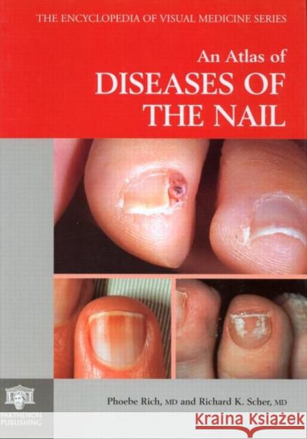 An Atlas of Diseases of the Nail Richard K. Scher Phoebe Rich Rich Rich 9781850705956 Informa Healthcare