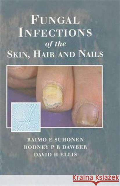 Fungal Infections of the Skin and Nails Raimo E. Suhonen Rodney P. R. Dawber David H. Ellis 9781853175893 Informa Healthcare