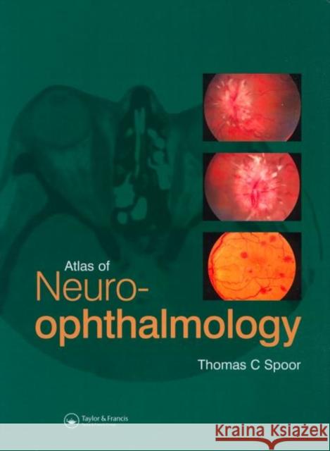 Atlas of Neuro-Ophthalmology Spoor, Thomas C. 9781853177736