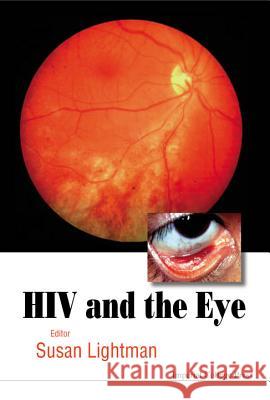 HIV and the Eye HIV and the Eye HIV and the Eye HIV and the Eye Susan Lightman 9781860940842