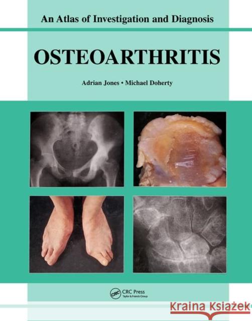 Oesteoarthritis: An Atlas of Investigation and Diagnosis Jones, Adrian 9781904392163
