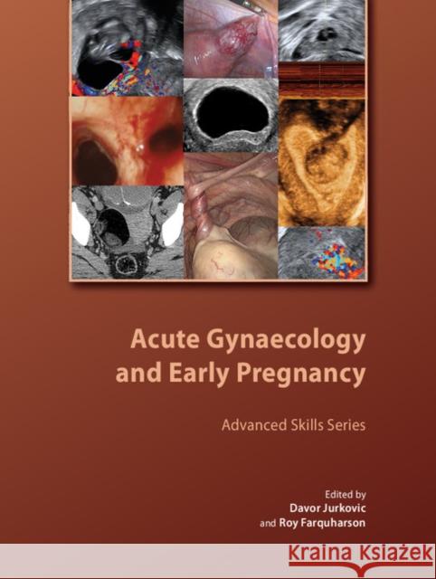 Acute Gynaecology and Early Pregnancy Davor Jurkovic (University College London), Roy Farquharson (University of Liverpool) 9781906985325