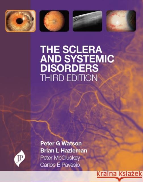 The Sclera and Systemic Disorders Peter G Watson 9781907816079 0