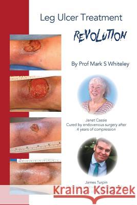 Leg Ulcer Treatment Revolution Mark S. Whiteley 9781908586056 Whiteley Publishing Ltd