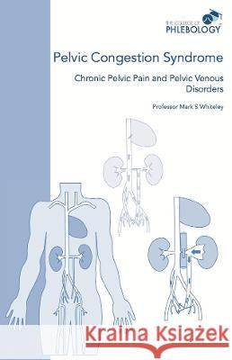 Pelvic Congestion Syndrome - Chronic Pelvic Pain and Pelvic Venous Disorders Mark S Whiteley   9781908586070 Whiteley Publishing Ltd