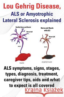 Lou Gehrig Disease, ALS or Amyotrophic Lateral Sclerosis Explained. ALS Symptoms, Signs, Stages, Types, Diagnosis, Treatment, Caregiver Tips, AIDS and Rymore, Robert 9781909151604 Imb Publishing