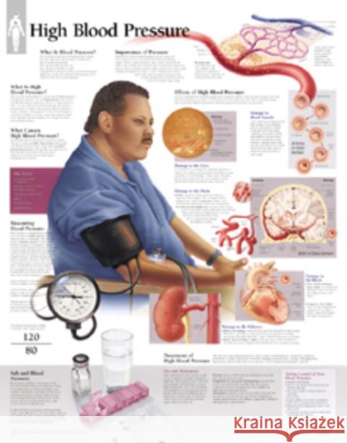 High Blood Pressure Laminated Poster Scientific Publishing 9781930633117 SCIENTIFIC PUBLISHING