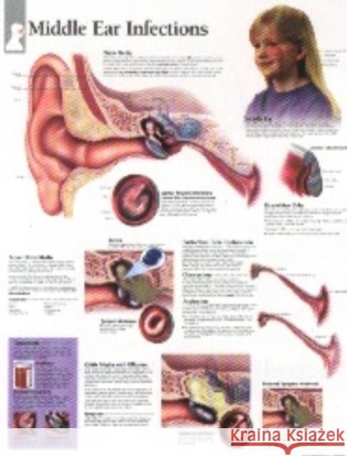 Middle Ear Infections Paper Poster Scientific Publishing 9781930633186 Scientific Publishing Limited