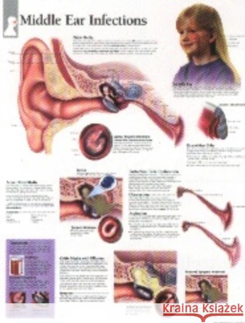 Middle Ear Infections Laminated Poster Scientific Publishing 9781930633193 Scientific Publishing Limited