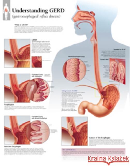 Understanding GERD (Gastroesophageal Reflux Disease) Paper Poster Scientific Publishing 9781930633209 Scientific Publishing Limited