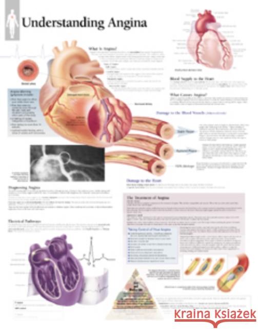 Understanding Angina Laminated Poster Scientific Publishing 9781930633230 Scientific Publishing Limited