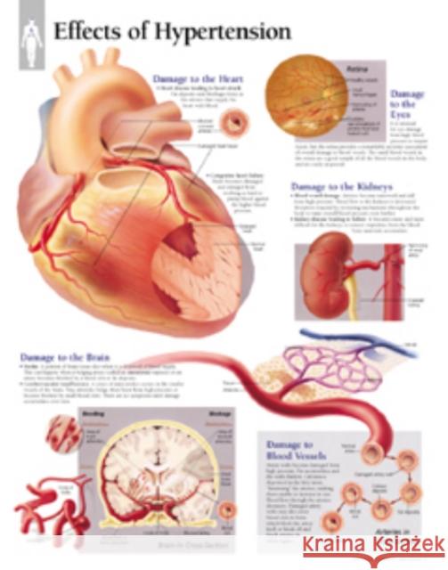 Effects of Hypertension Paper Poster Scientific Publishing 9781930633247 SCIENTIFIC PUBLISHING