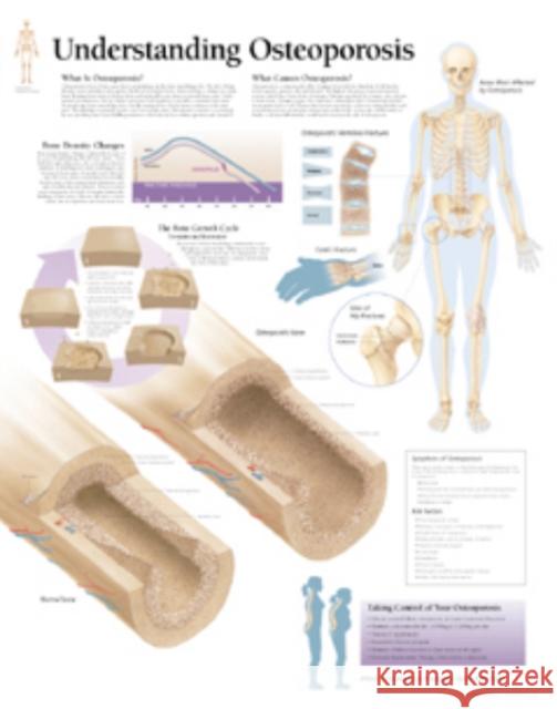 Understanding Osteoporosis Paper Poster Scientific Publishing 9781930633308 Scientific Publishing Limited