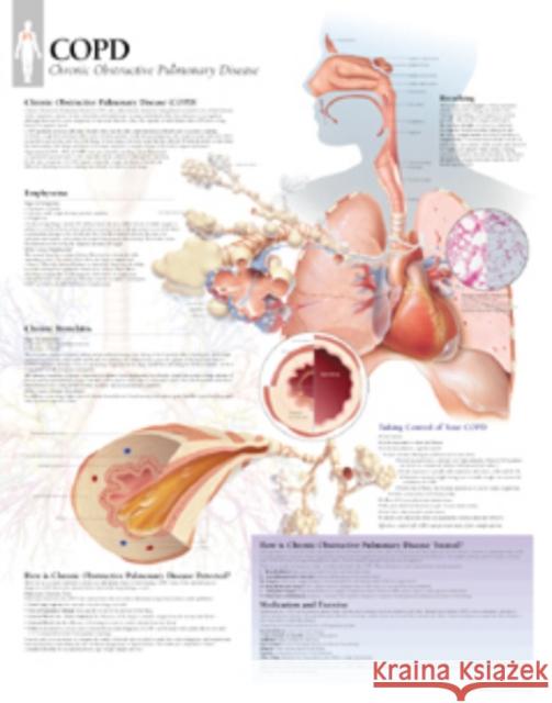 COPD (Chronic Obstructive Pulmonary Disease) Laminated Poster Scientific Publishing 9781930633353 Scientific Publishing Limited