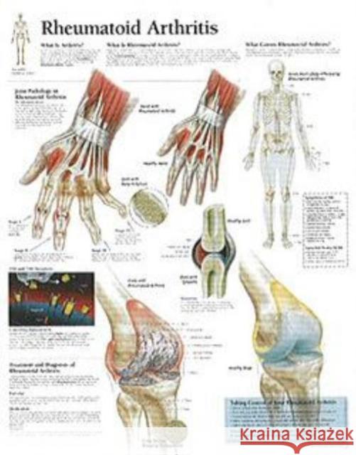 Rheumatoid Arthritis Paper Poster Scientific Publishing 9781930633384 Scientific Publishing Limited