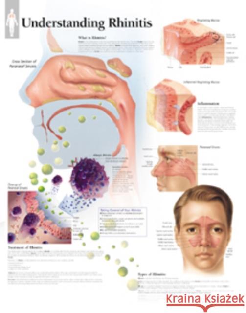 Understanding Rhinitis Laminated Poster Scientific Publishing 9781930633414 Scientific Publishing Limited