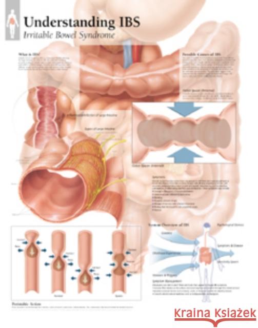 Understanding IBS Laminated Poster Scientific Publishing 9781930633513 Scientific Publishing Limited