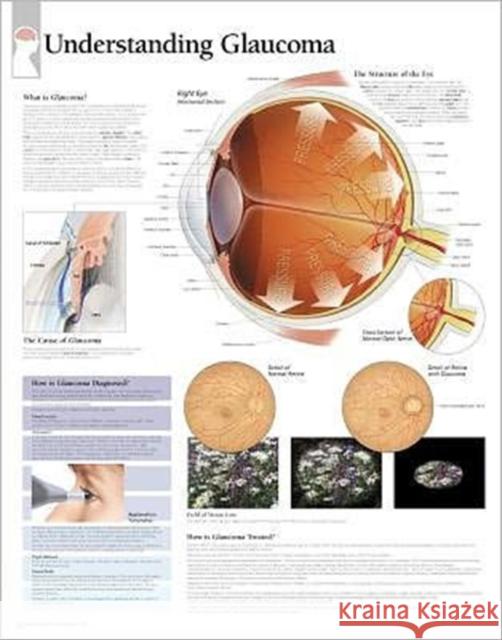 Understanding Glaucoma Laminated Poster Scientific Publishing 9781930633872 Scientific Publishing Limited
