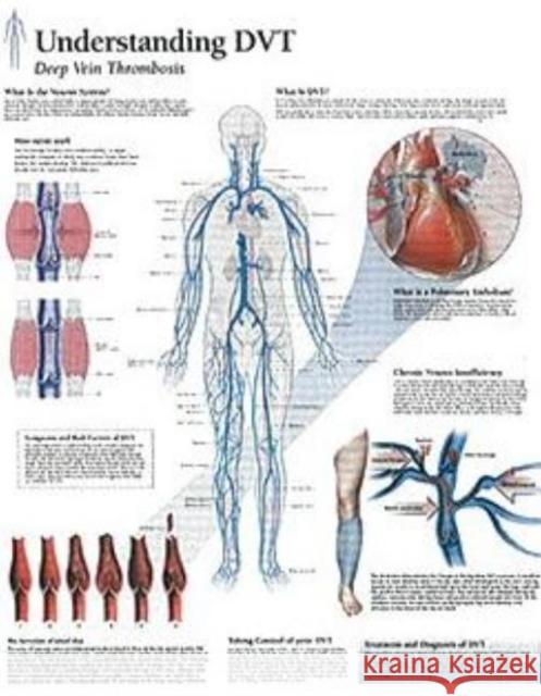 Understanding DVT Laminated Poster Scientific Publishing 9781932922004 Scientific Publishing