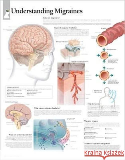 Understanding Migraines Laminated Poster Scientific Publishing 9781932922189 Scientific Publishing