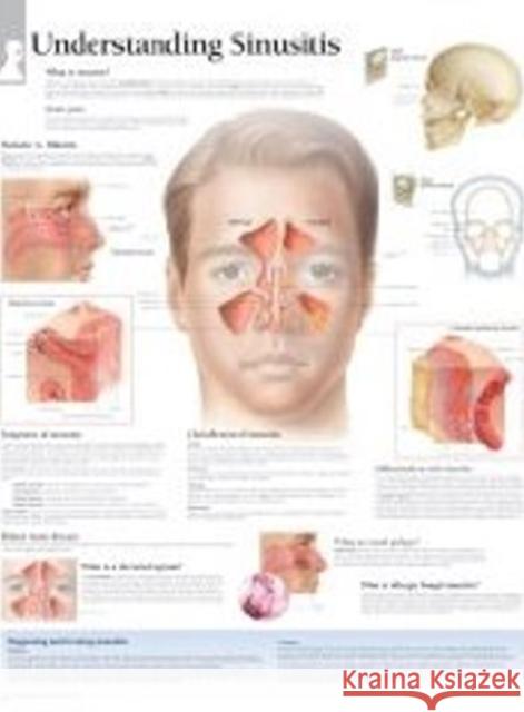 Understanding Sinusitis Laminated Poster Scientific Publishing 9781932922691 Scientific Publishing