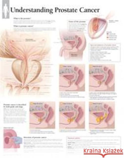 Understanding Prostate Cancer Laminated Poster Scientific Publishing 9781935612292 Scientific Publishing Limited