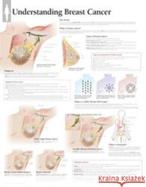 Understanding Breast Cancer Paper Poster Scientific Publishing 9781935612308 Scientific Publishing Limited