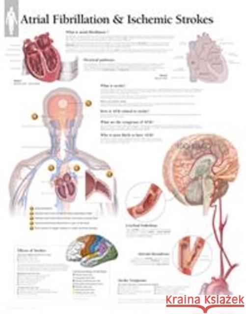 Atrial Fib & Ischemic Strokes Paper Poster Scientific Publishing 9781935612322 Scientific Publishing Limited