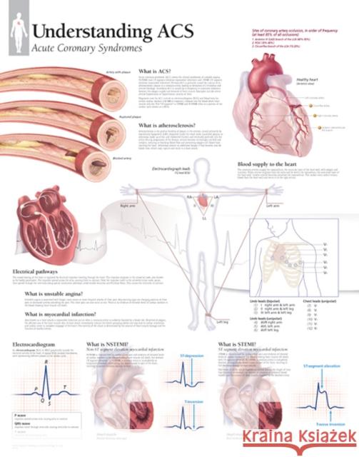 Understanding ACS (Acute Coronary Syndrome) Laminated Poster Scientific Publishing 9781935612490 Scientific Publishing Limited