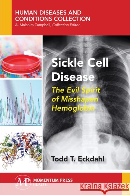 Sickle Cell Disease: The Evil Spirit of Misshapen Hemoglobin Todd T. Eckdahl 9781944749750 Momentum Press