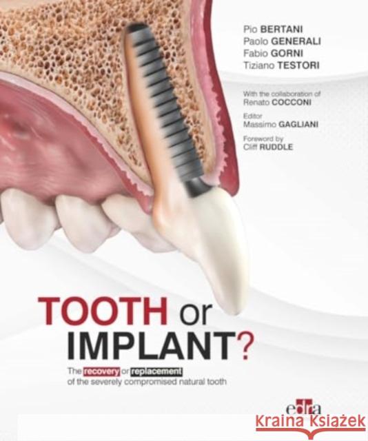 Tooth or Implant Tiziano Testori 9781957260525 Edra Publishing US LLC