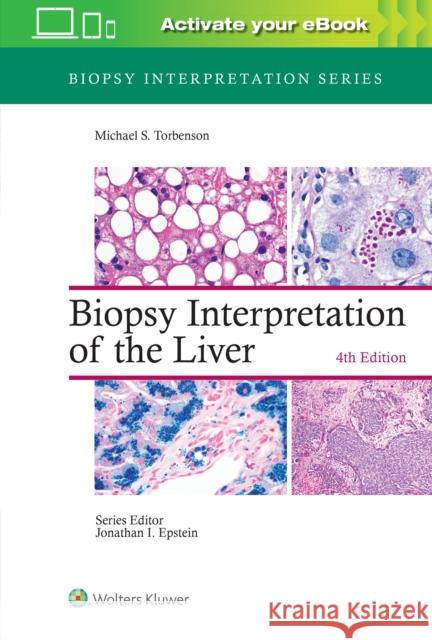 Biopsy Interpretation of the Liver Michael Torbenson 9781975157296 Wolters Kluwer Health