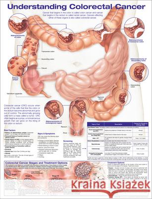 Understanding Colorectal  Cancer Anatomical Chart Anatomical Chart Company 9781975192396