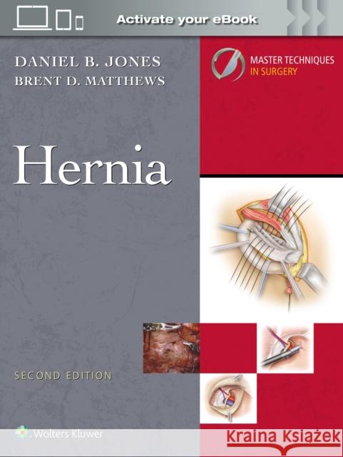 Master Techniques in Surgery: Hernia: Print + eBook with Multimedia Daniel B. Jones Brent D. Matthews 9781975222291