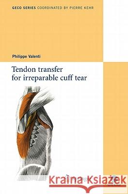 Tendon Transfer for Irreparable Cuff Tear Valenti, Philippe 9782817800486 0