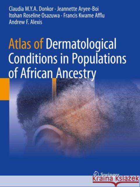 Atlas of Dermatological Conditions in Populations of African Ancestry Claudia M.Y.A. Donkor, Jeannette Aryee-Boi, Itohan Roseline Osazuwa 9783030726195 Springer International Publishing