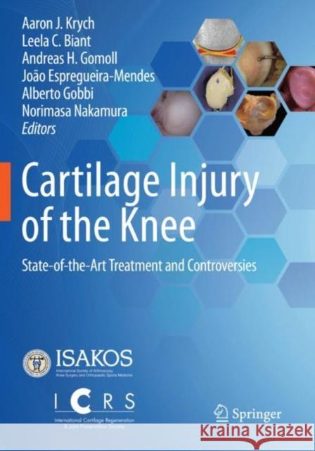 Cartilage Injury of the Knee: State-Of-The-Art Treatment and Controversies Krych, Aaron J. 9783030780531 Springer International Publishing