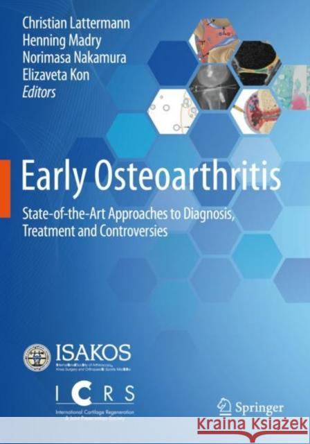 Early Osteoarthritis: State-Of-The-Art Approaches to Diagnosis, Treatment and Controversies Lattermann, Christian 9783030794873 Springer International Publishing