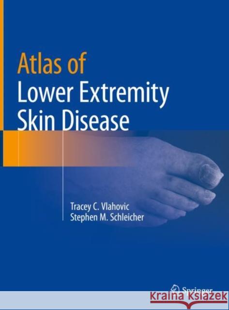 Atlas of Lower Extremity Skin Disease Tracey C. Vlahovic Stephen M. Schleicher 9783031079498 Springer